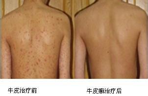 19背部牛皮癣2.jpg