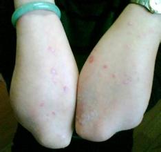 重庆银屑病那里医院治疗好 重庆银屑病那里医院治疗好