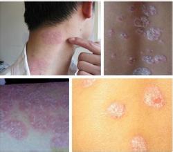 老年牛皮癣患者常见的补钙误区 老年牛皮癣患者常见的补钙误区