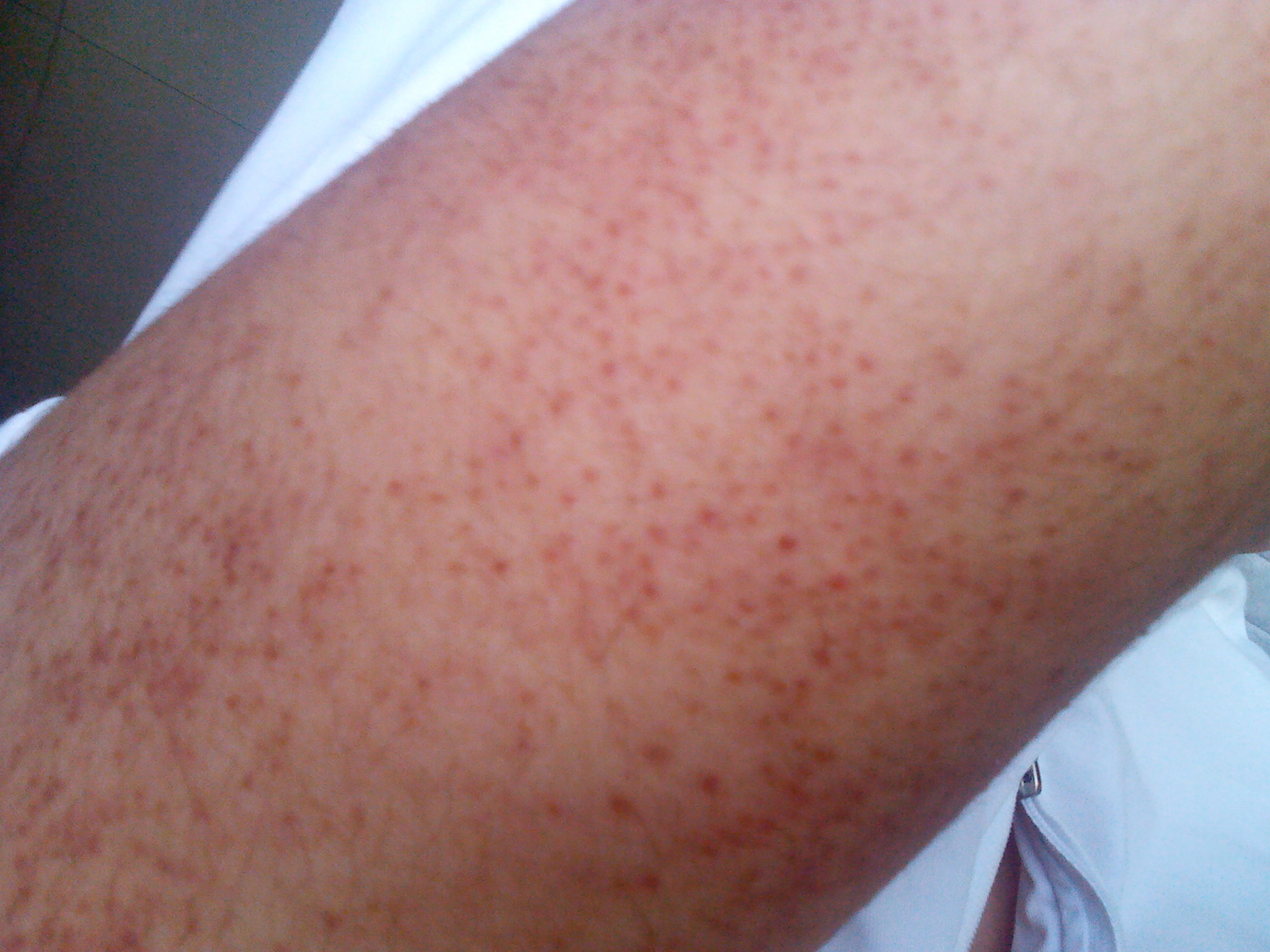 重庆治疗银屑病医院哪家比较好 重庆治疗银屑病医院哪家比较好