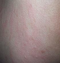 ţƤѢ��������֢״����Щ