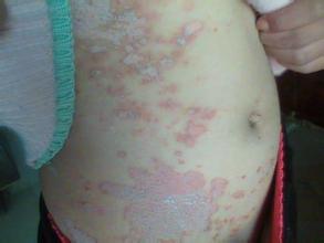 重庆市治银屑病效果最好的是哪个医院 重庆市治银屑病效果最好的是哪个医院